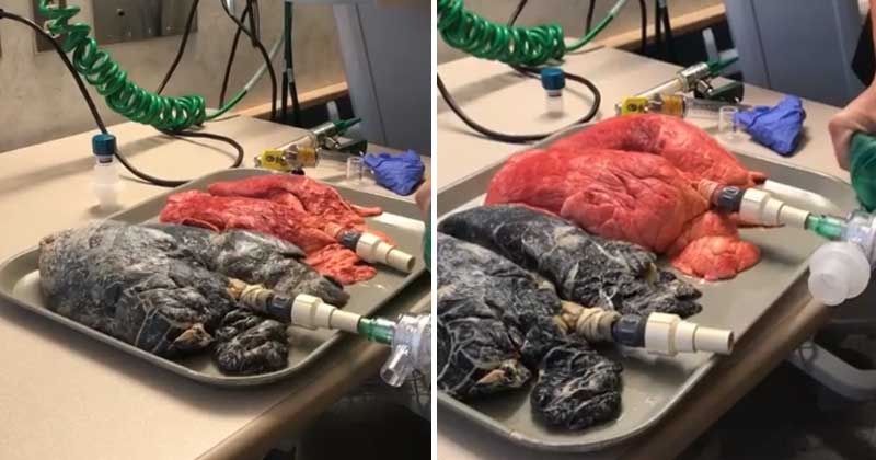 Smoker’s Lungs vs Non-Smoker’s Lungs