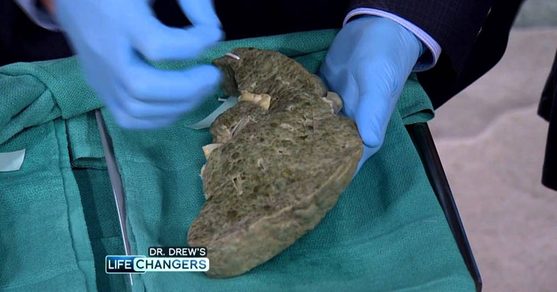 What Alcohol Can Do To Your Liver