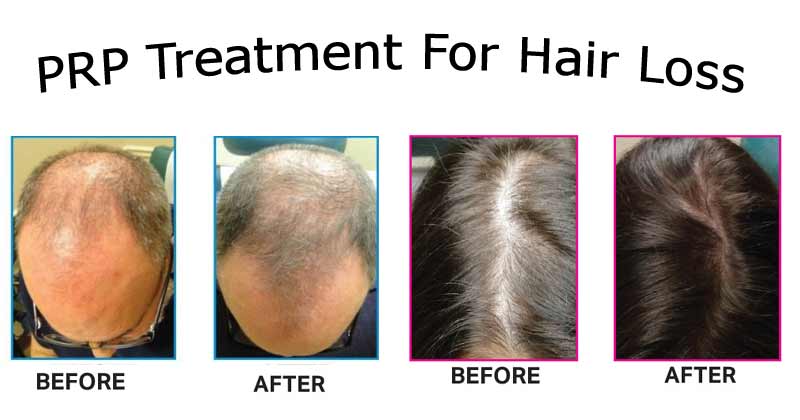 PRP Treatment For Hair Loss