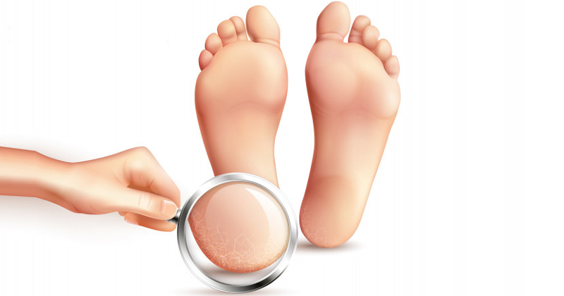 Home Remedies For Cracked Heels