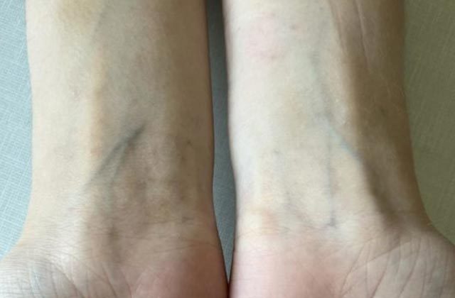 Why Do Veins Look Blue