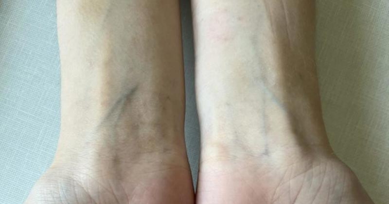 Why Do Veins Look Blue