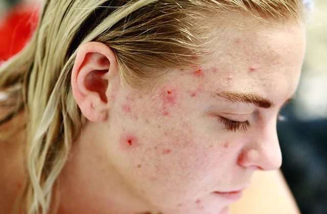 What Are Blind Pimples | How To Treat Blind Pimples