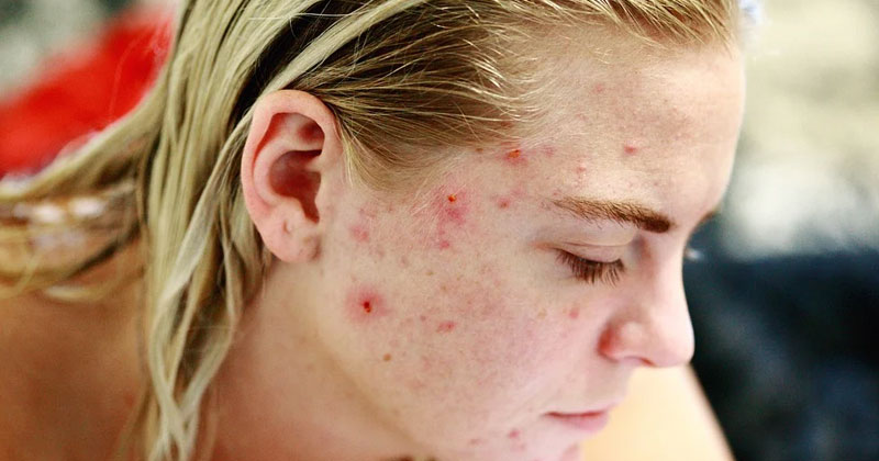 What Are Blind Pimples | How To Treat Blind Pimples