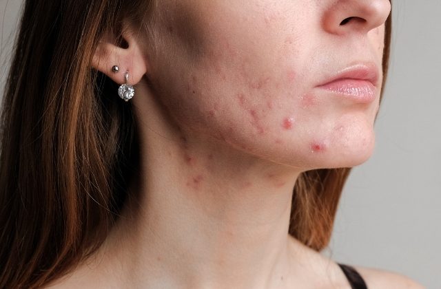 Suffering From Adult Acne? Here’s How To Treat Hormonal Acne