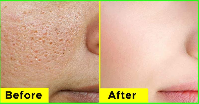 Face With Open Pores | Home Remedies Open Pores