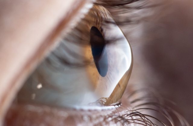 Keratoconus