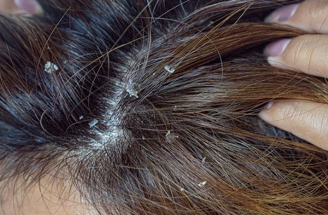 Easy Home Remedies For Dry Scalp
