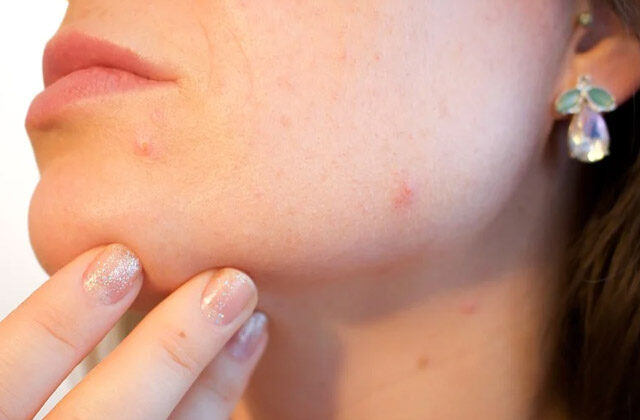Foods That Can Cause Acne