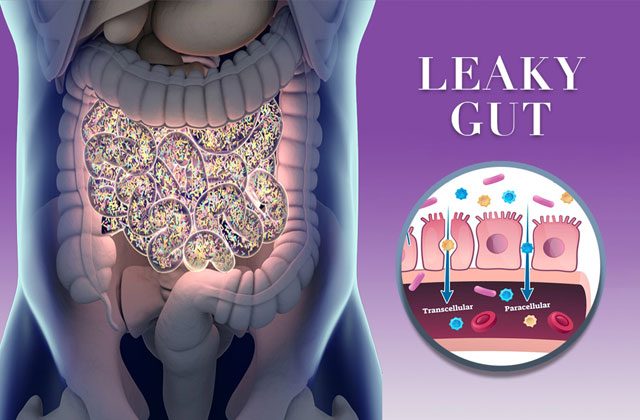 leaky gut